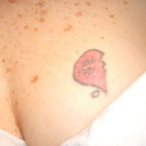 Tattoo before laser removal at Ink Blasters