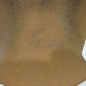 The same tattoo after seven treatments