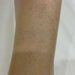 The same tattoo after twelve laser removal treatments