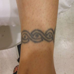 An eight-year-old professional tattoo, seven square inches, before laser removal
