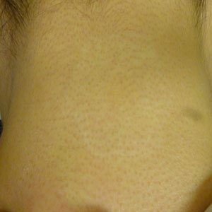 The same tattoo after nine treatments