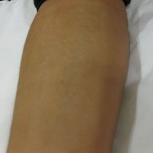 The same tattoo after twelve treatments