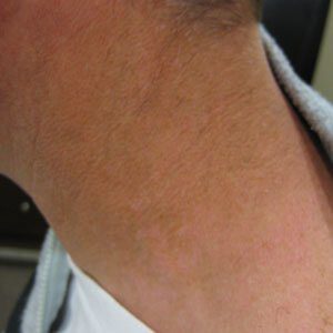 The same tattoo after eight treatments