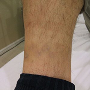 The same tattoo after twelve treatments