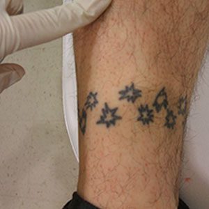 Four square inch professional tattoo before removal