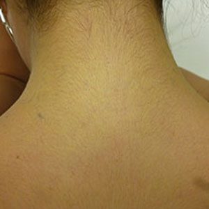 The same tattoo after nine treatments