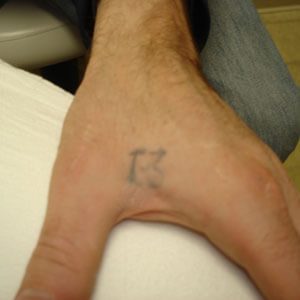 Amateur tattoo under one square inch before removal