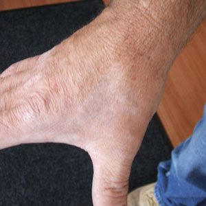 The same tattoo after two treatments