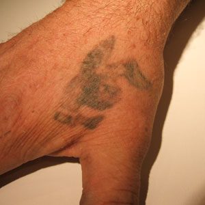 Twenty year old amateur tattoo before removal