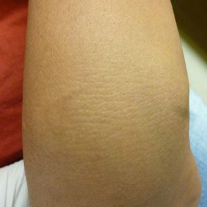 The same tattoo after ten laser removal treatments