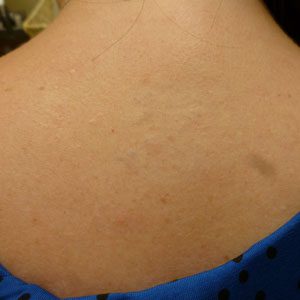 The same tattoo after nine treatments