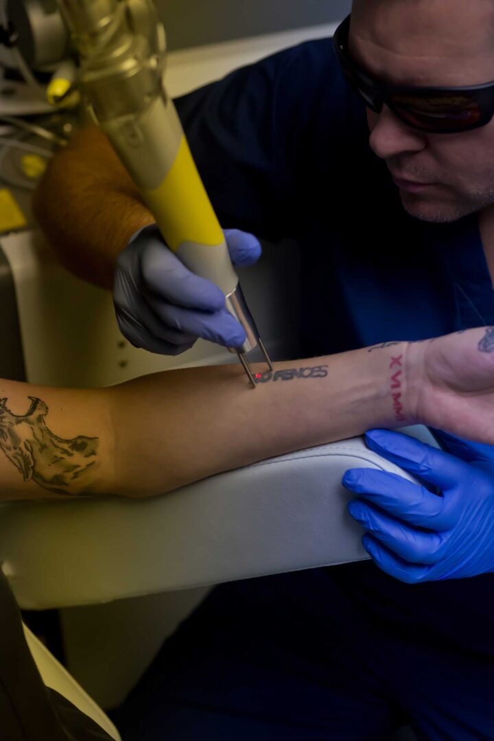 Laser tattoo removal treatment on a forearm at Ink Blasters in Livonia, Michigan