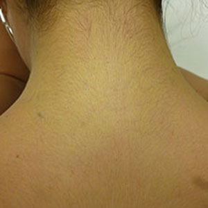 Image of Tattoo After Laser Tattoo Removal in Detroit | Ink Blasters Metro Detroit Tattoo Removal